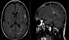 Hiperintens Lezyon Nedir? Hiperintens Lezyon Nedir?