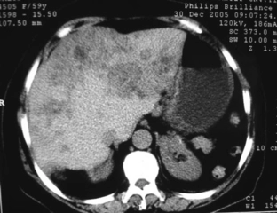 Hipodens Kistik Lezyon Nedenleri Hipodens Kistik Lezyon Nedenleri