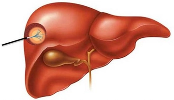 Karaciğerde Lezyon Belirtileri ve Tedavisi Karaciğerde Lezyon Belirtileri ve Tedavisi