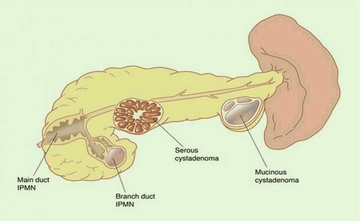 Kistik Lezyon Belirtileri ve Tedavisi