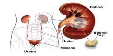 Bbrekte Hipodens Lezyon Nedir